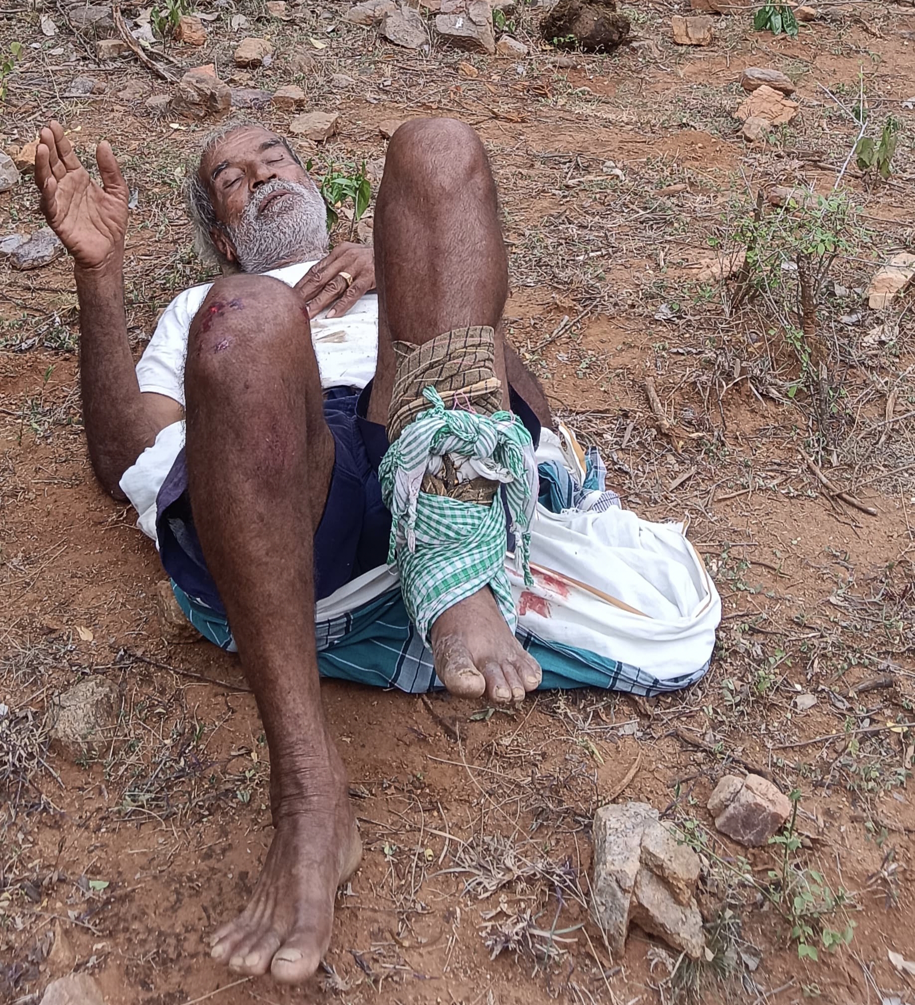 ಕಾಡಾನೆ ದಾಳಿ : ವ್ಯಕ್ತಿಯ ಕಾಲು ಮುರಿತ